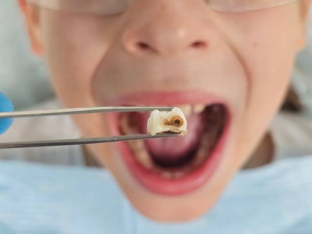 Best Emergency Dentist for Lost Fillings or Crowns in Thorndale, PA